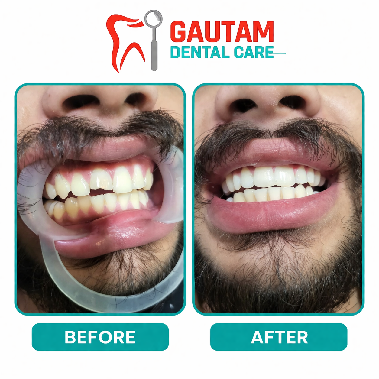 Root Canals