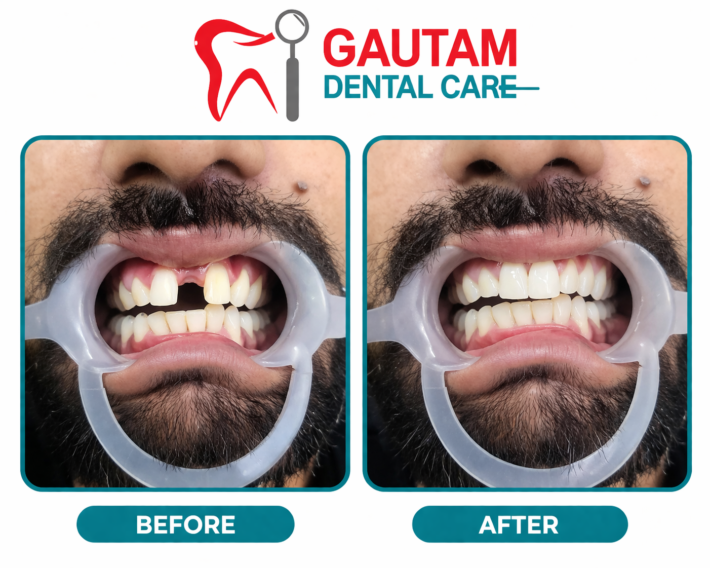 Root Canals