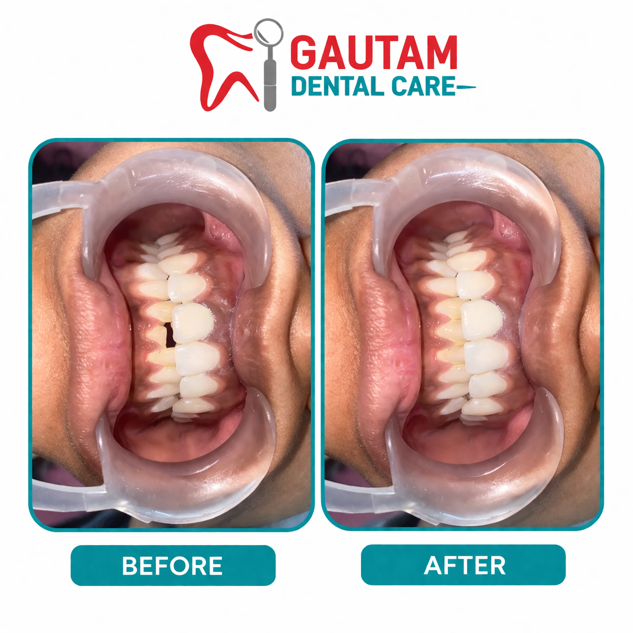 Root Canals