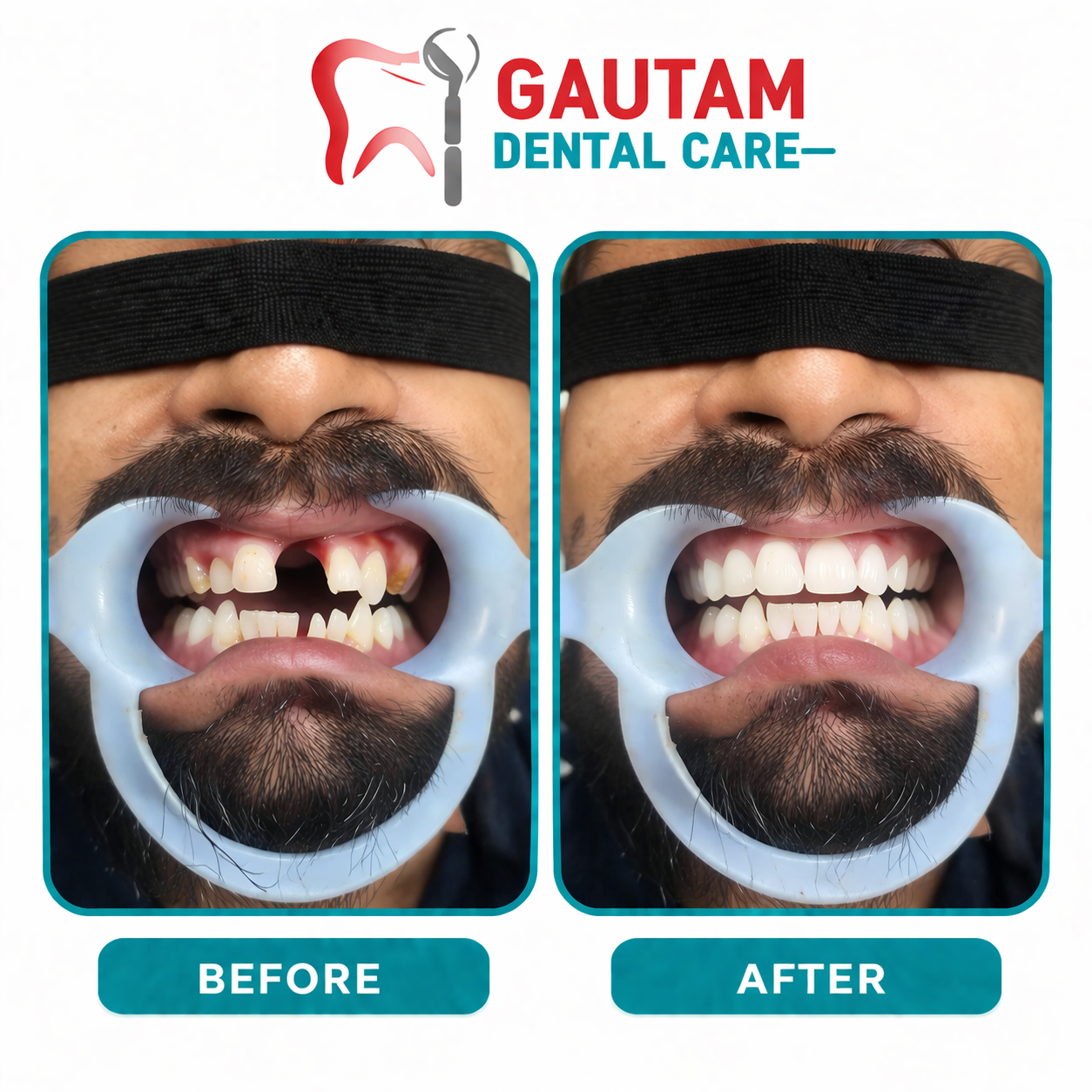 Root Canals