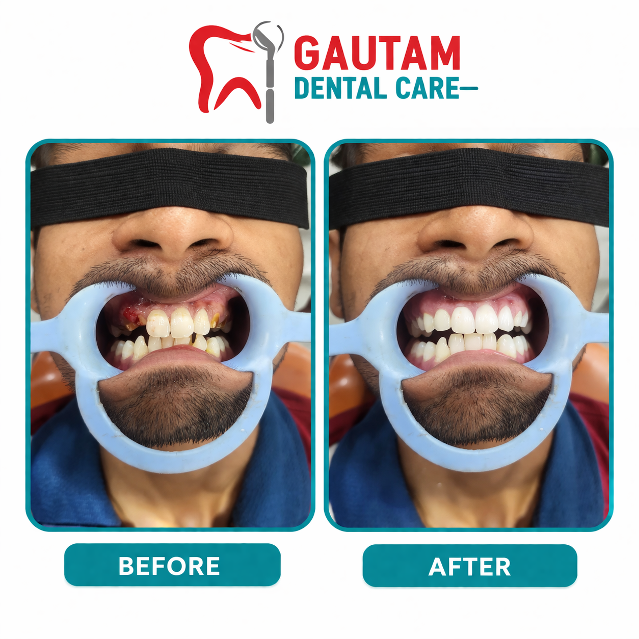 Root Canals